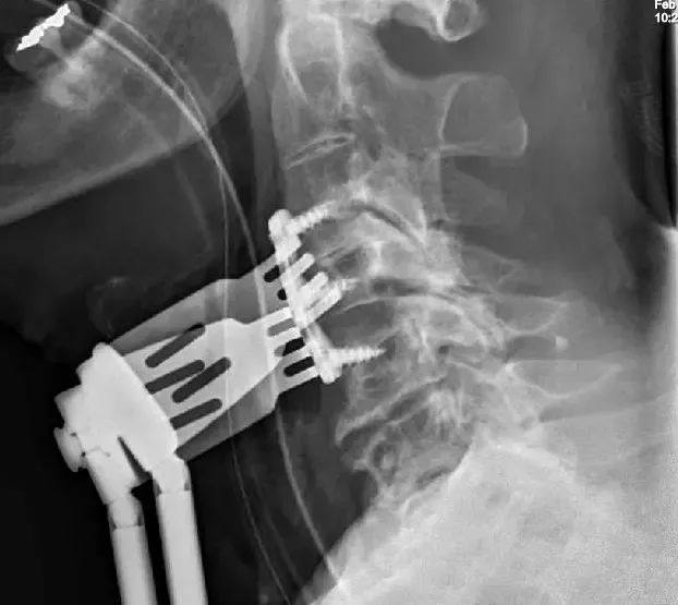 Se realizó discectomía cervical anterior y fusión para aliviar la presión de la médula espinal, limpiando disco y fusión mediante injerto óseo y placa y tornillos desde la parte frontal