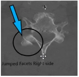Facetas saltadas en el lado derecho