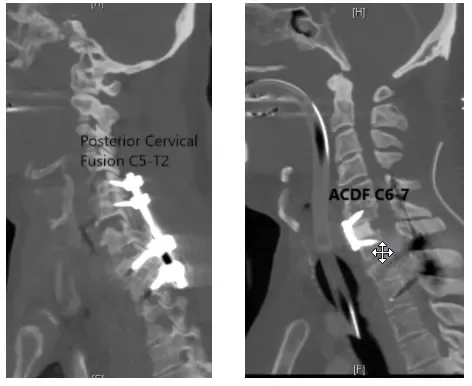 Fusión espinal posterior C5-T2