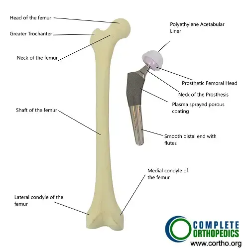 Componentes de la prótesis total de cadera