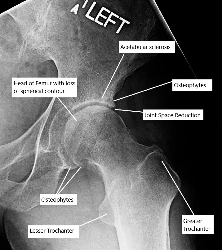 Osteoarthritis of the hip joint on an X-ray. Osteoarthritis of the hip joint on an X-ray.