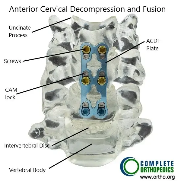 Descompresión cervical anterior y fusión