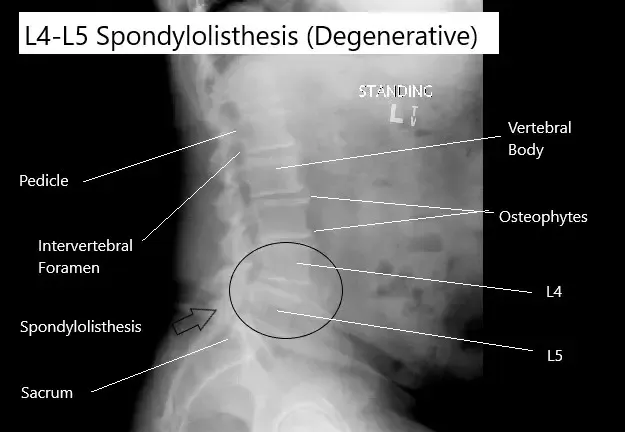 Radiografía que muestra espondilolistesis degenerativa de las vértebras L4-L5.