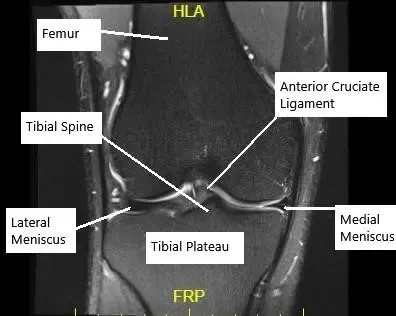 Resonancia magnética de la rodilla en corte coronal que muestra un LCA intacto.