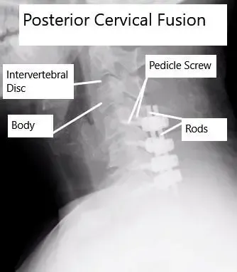 AP and Lateral View X-rays of Posterior Cervical Laminectomy and Fusion