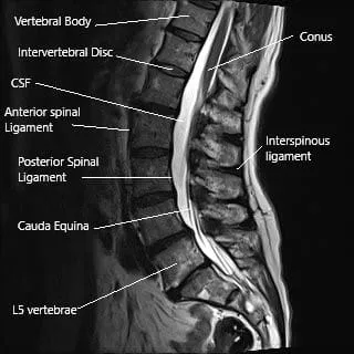 Resonancia magnética de la columna lumbar que muestra el ligamento interespinoso y el proceso espinoso.
