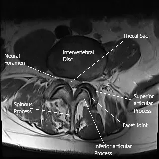 La cirugía láser de columna puede utilizarse para tratar una hernia de disco intervertebral, como se observa en esta sección de resonancia axial de la columna lumbar.