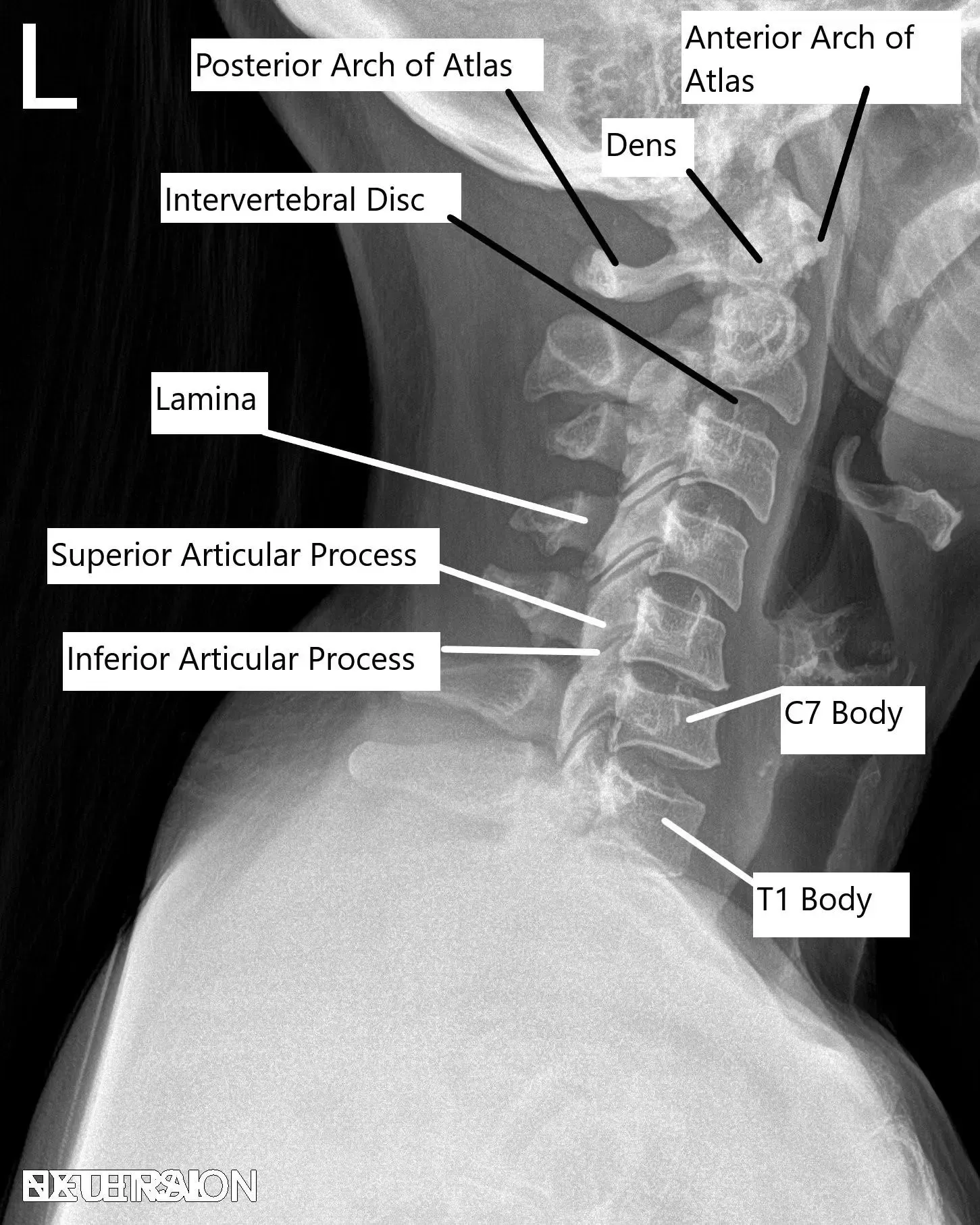Radiografía de la columna cervical en vista lateral.