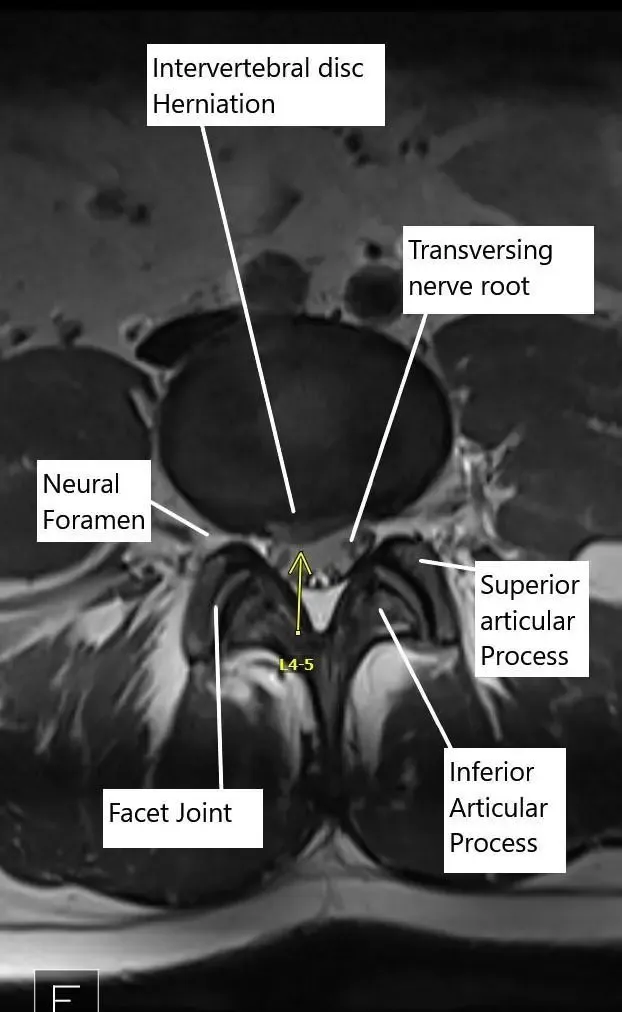 Sección axial de la resonancia magnética lumbosacra en el nivel L4-L5.