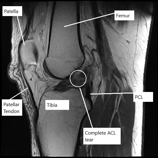 Resonancia magnética de la rodilla izquierda que muestra una rotura completa del LCA.