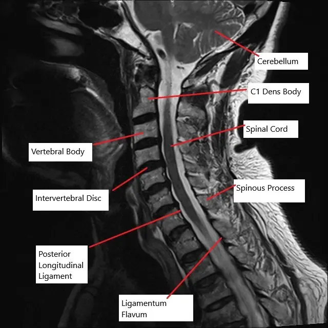 Resonancia magnética de la columna cervical en la sección sagital muestra múltiples discos intervertebrales abultados.