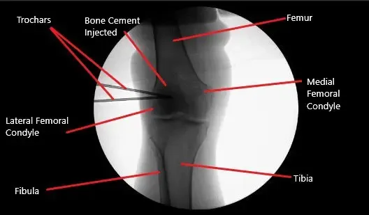 Imagen fluoroscópica intraoperatoria de la rodilla derecha mostrando inyección ósea de fosfato tricálcico.