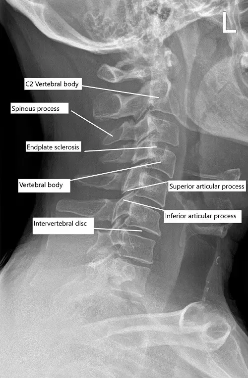 Radiografía preoperatoria de la columna cervical en vista lateral.