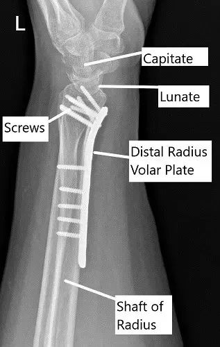 Post-operative x-ray of the wrist in lateral view.