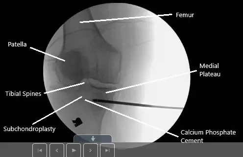 Imagen fluoroscópica intraoperatoria de subcondroplastia.