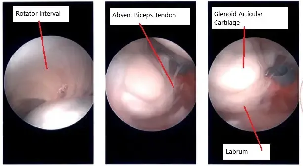 Intraoperative arthroscopic image of the shoulder.