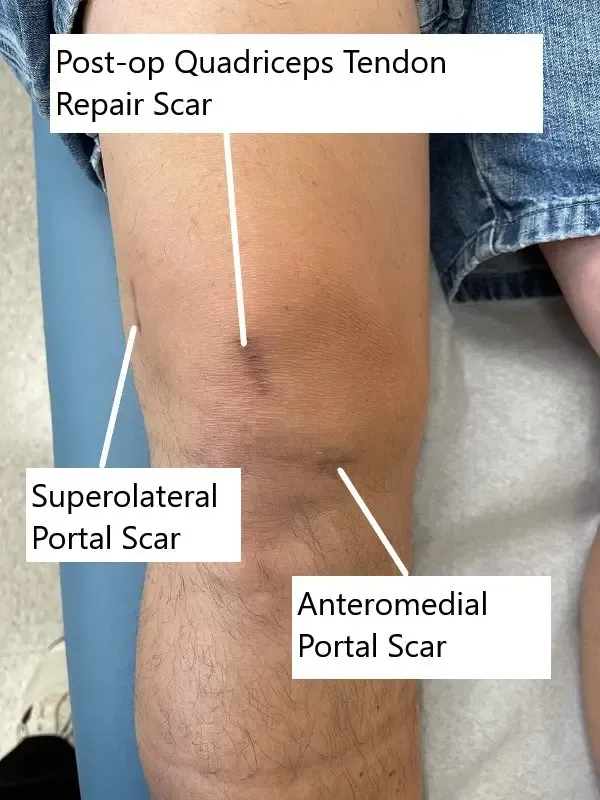 Imágenes postoperatorias que muestran la cicatriz del autoinjerto del tendón del cuádriceps y la amplitud de movimiento.