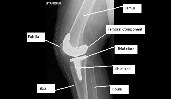 Radiografía que muestra una cirugía de reemplazo total de rodilla en un paciente con AVN de rodilla.
