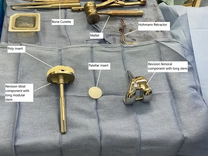 Implantes intraoperatorios e instrumentos utilizados en cirugía de revisión de rodilla.