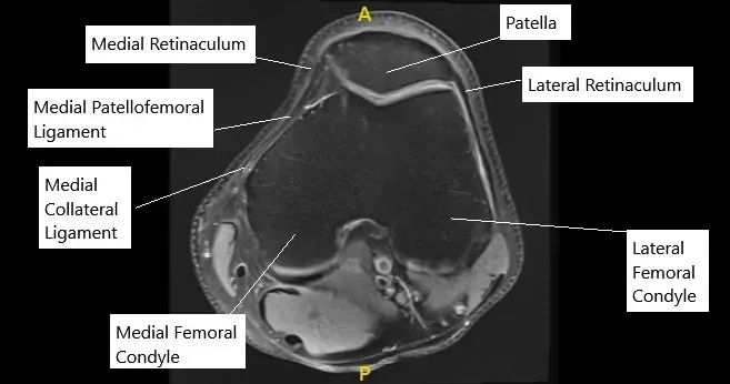 La resonancia magnética de rodilla en la sección axial mostró un MPFL normal.