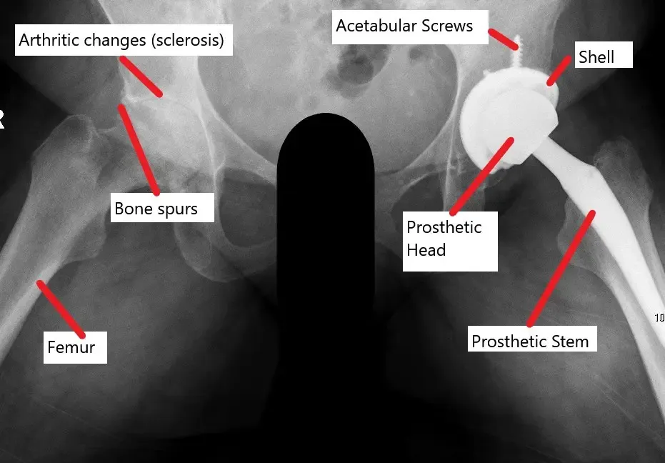 Radiografía que muestra un reemplazo total de cadera con una articulación artrítica contralateral.