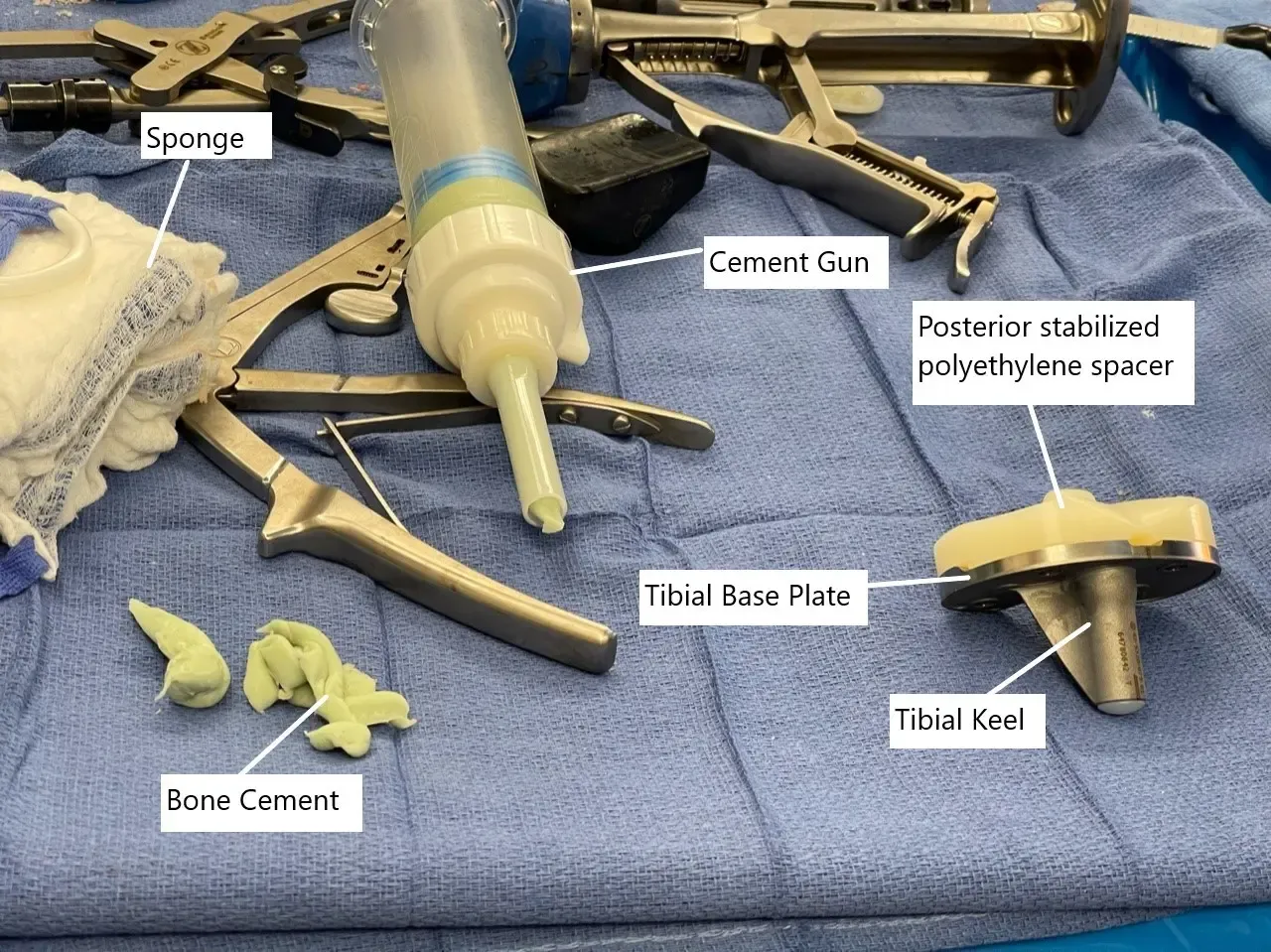 Intraoperative image showing the tibial component with polyethylene spacer.
