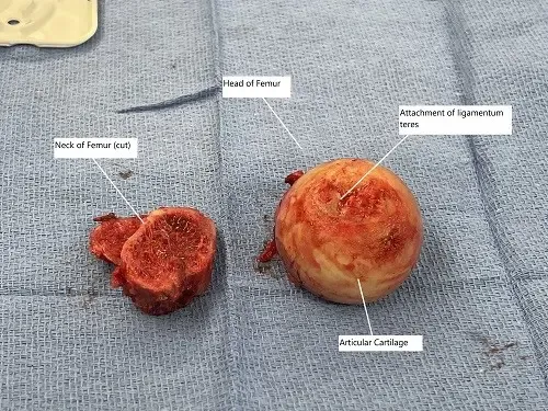 Imagen intraoperatoria que muestra la cabeza extirpada del fémur y el cuello del fémur.