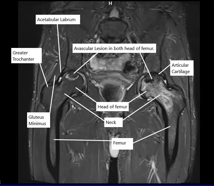 Resonancia magnética en la sección coronal que muestra lesiones de necrosis avascular en ambas caderas.