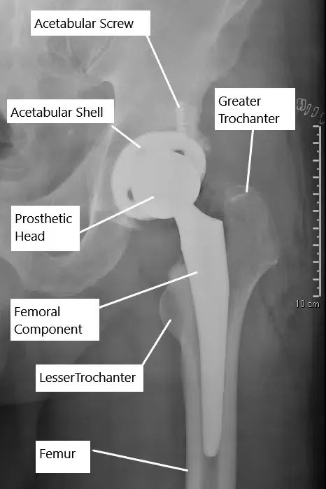 Radiografía que muestra una prótesis total de cadera no cementada.