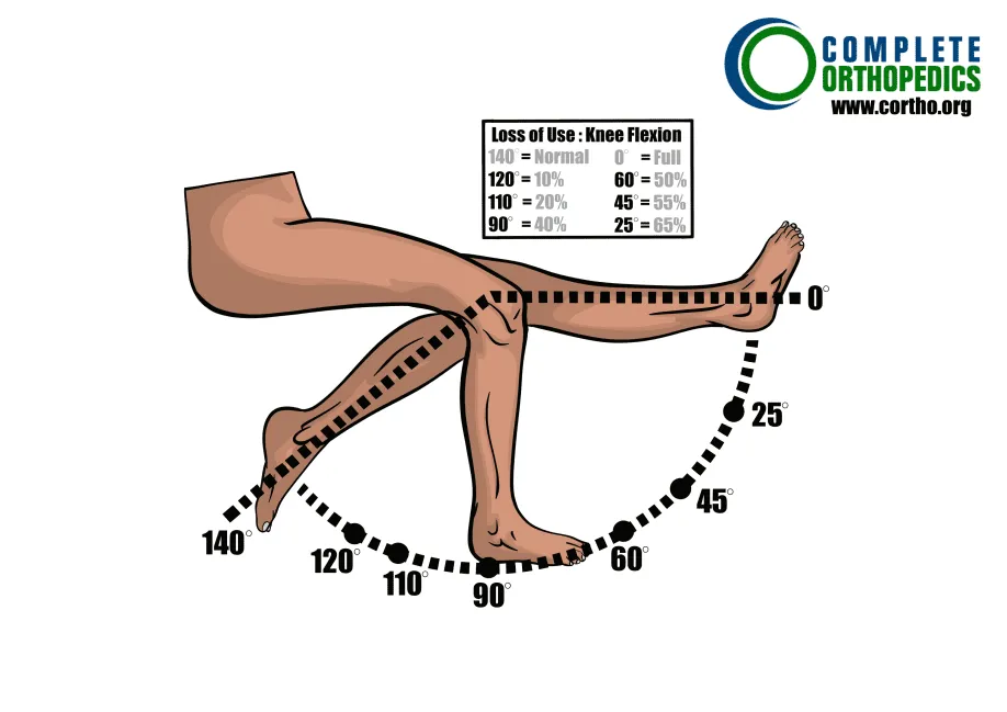 Flexión de rodilla para evaluar la pérdida de movimiento y calcular la pérdida programada de uso para pacientes de compensación laboral