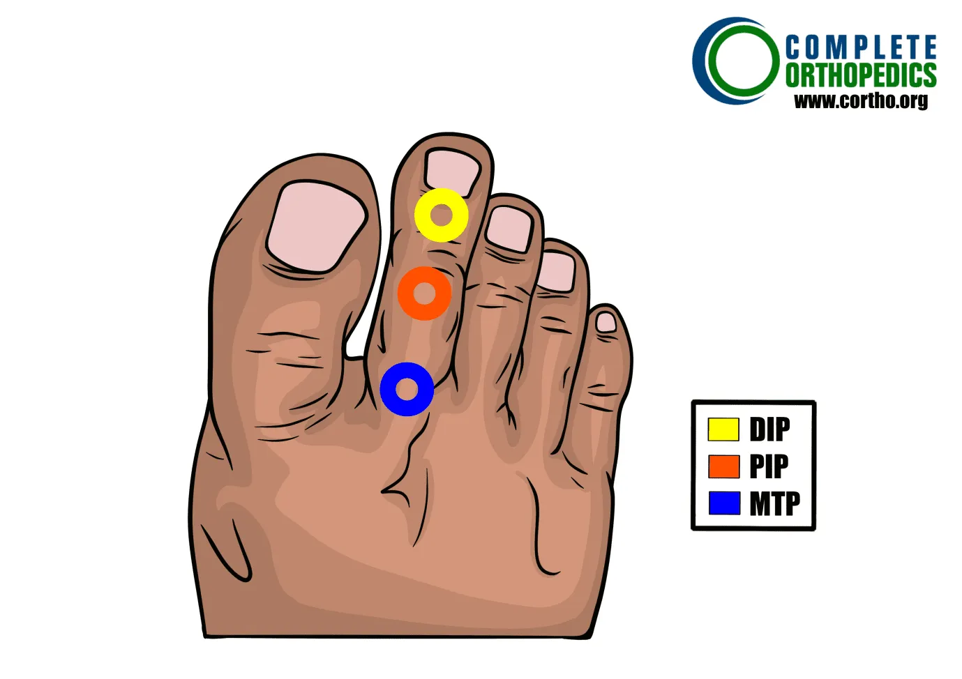 articulación metatarsofanángea y articulación interfalángica proximal y articulación interfalángica distal para evaluar la pérdida de movimiento y calcular la pérdida de uso programada para pacientes de compensación laboral