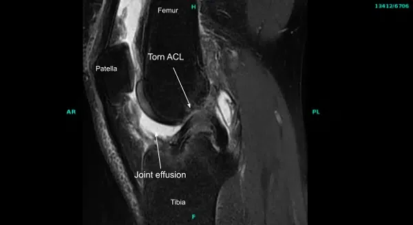 Resonancia magnética de la articulación de la rodilla derecha