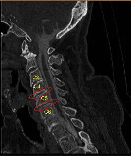 Espondilótico cervical