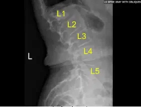 Estado postoperatorio de la radiografía lumbar de la columna tras la vertebroplastia de la vista sagital en L1