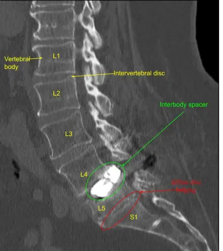 Muestra de laminectomía y fusión  
