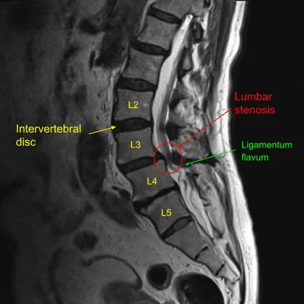 Vista sagital de la resonancia preoperatoria de la columna lumbar