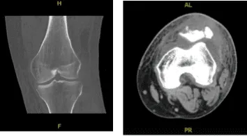 CT - Left Knee Contrast