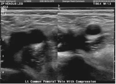 Doppler venous left lower extremity