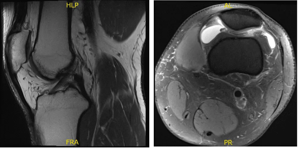 Fig. 1 Resonancia magnética de la rodilla izquierda en secciones sagital y coronal. 