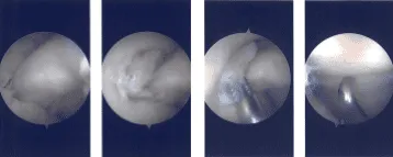 Intraoperative Arthroscopy Images