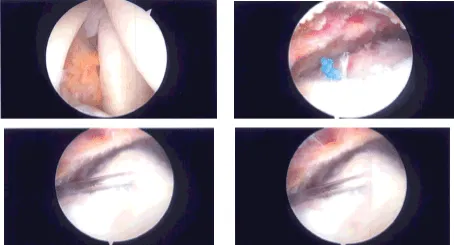 Intraoperative Arthroscopy Images
