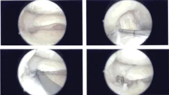 Intraoperative Arthroscopy Images