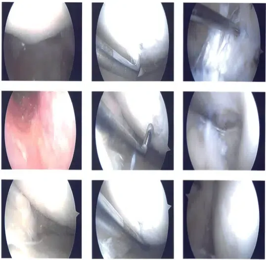 Intraoperative images