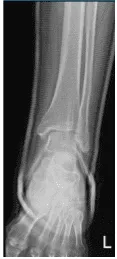 Radiografía del tobillo izquierdo completa: 3 o más vistas