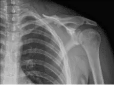Clavícula izquierda en posición AP