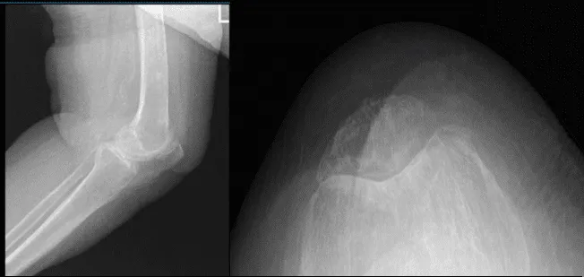 Radiografía de rodilla izquierda con vistas oblicuas 3