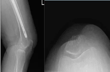 Radiografía de la rodilla izquierda con rótula