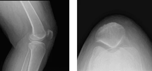 Radiografía de la rodilla izquierda completa con rótula