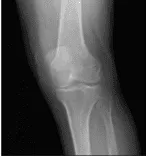 Left knee X-ray AP and Lateral with oblique views