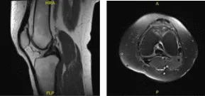 MRI -3 T Left Knee Non-contrast
